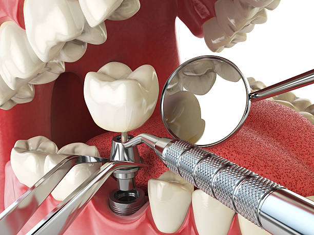 Best Dental Abscess Treatment in Harrisburg, SD